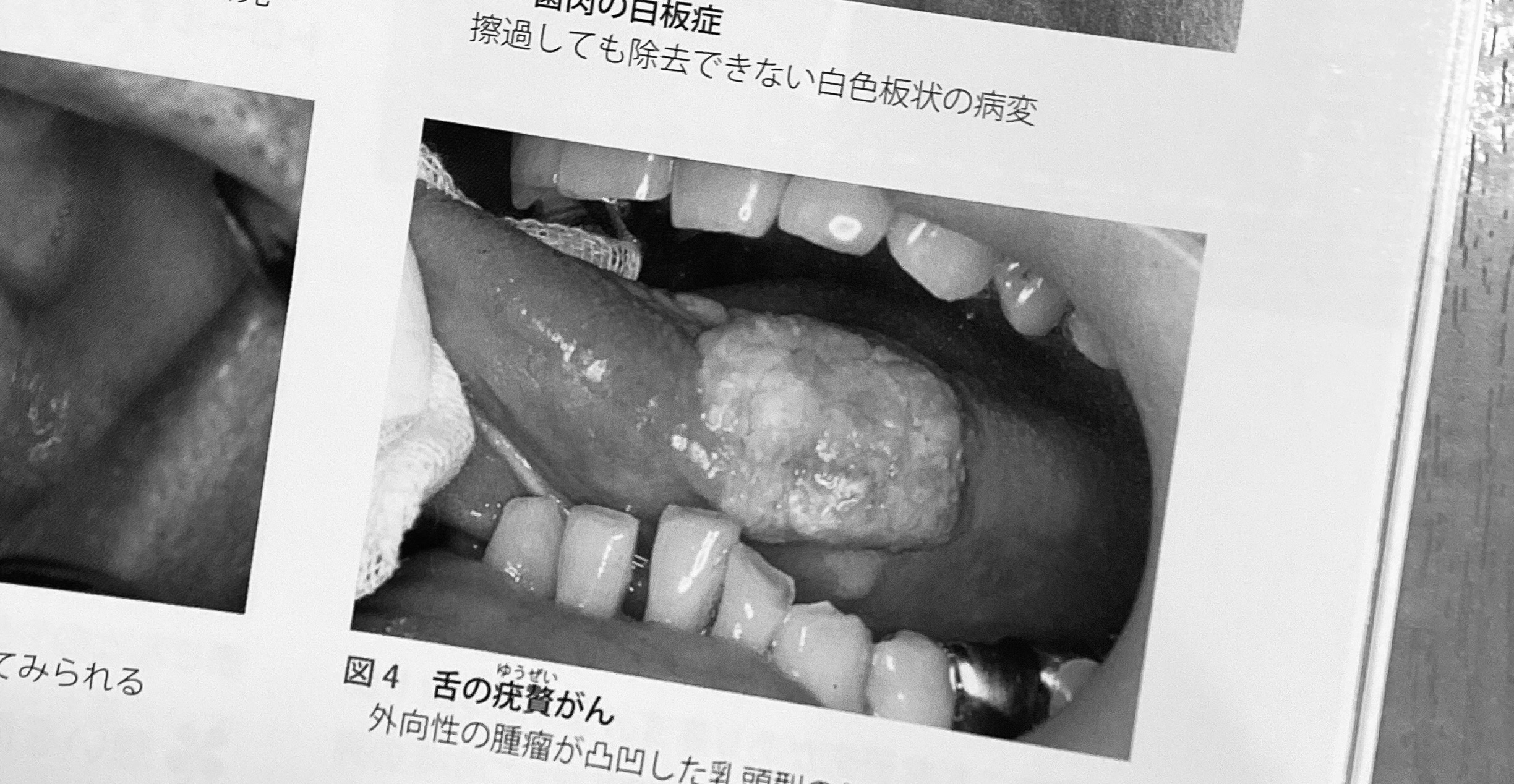 舌ガン👅 | ゆうだい歯科医院